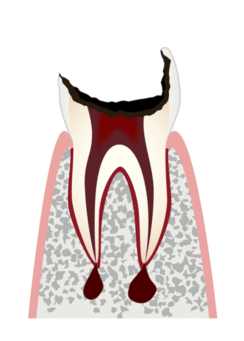 歯の頭の部分(歯冠)が大きく失われた歯